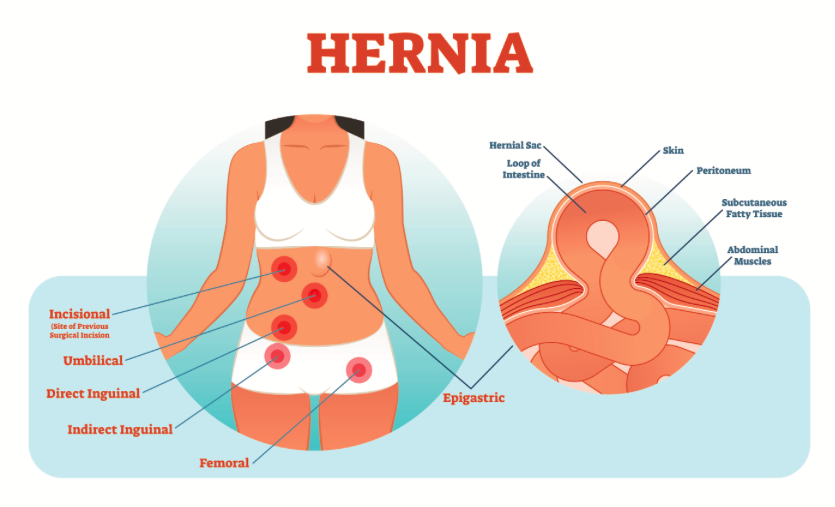 Hernias: Types, Symptoms, and When to Seek Urgent Care - MD Express Urgent  Care